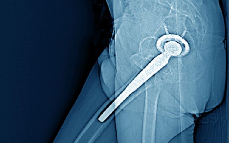 Lire la suite à propos de l’article Prothèse de hanche : les mouvements à éviter avec un implant prothétique