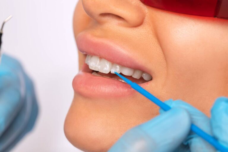 Lire la suite à propos de l’article Quelles solutions s’offrent à vous si vos dents sont tachées ?